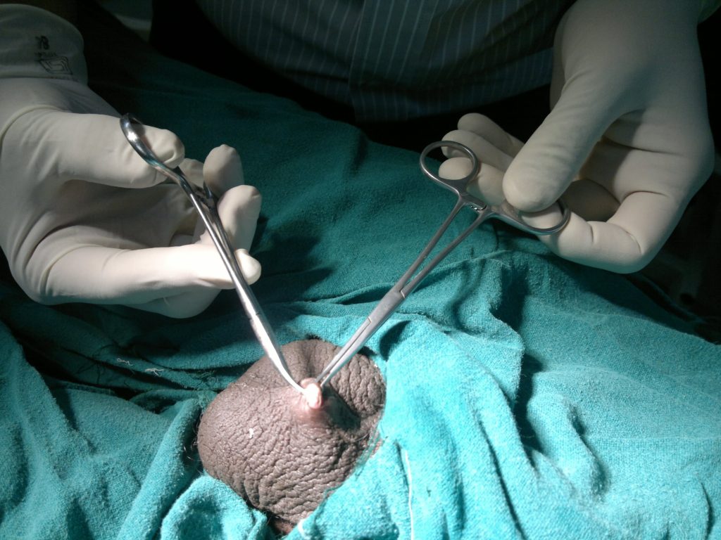 How Long After a Vasectomy Can I Drive a Car