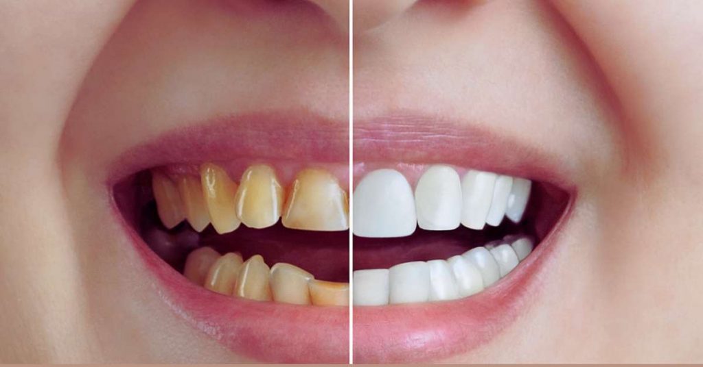 How Can I Make My Teeth Longer?