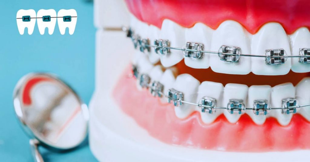 Do Bottom Teeth Move Faster Than Top with Braces?
