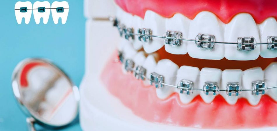 Do Bottom Teeth Move Faster Than Top with Braces?