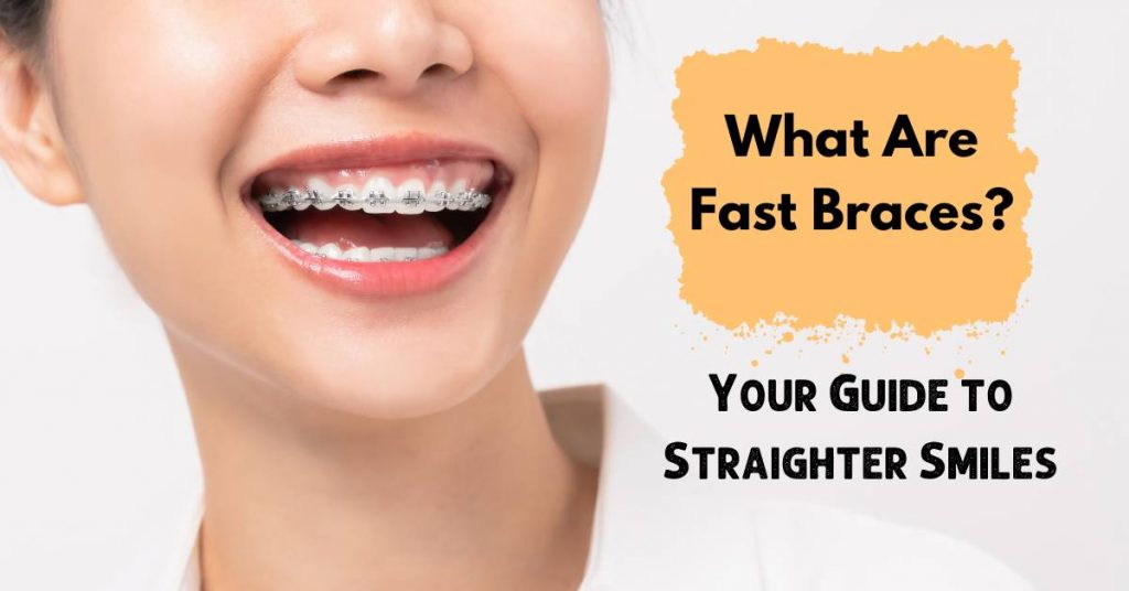 What Are Fast Braces?