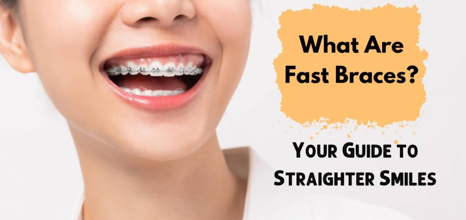 What Are Fast Braces?