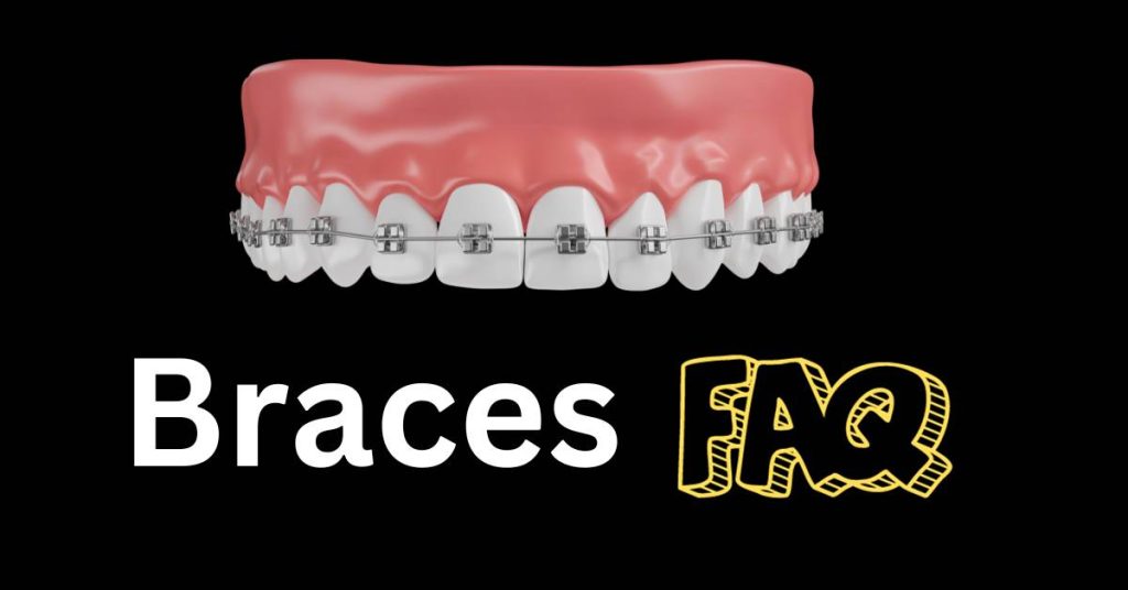 Braces Faqs