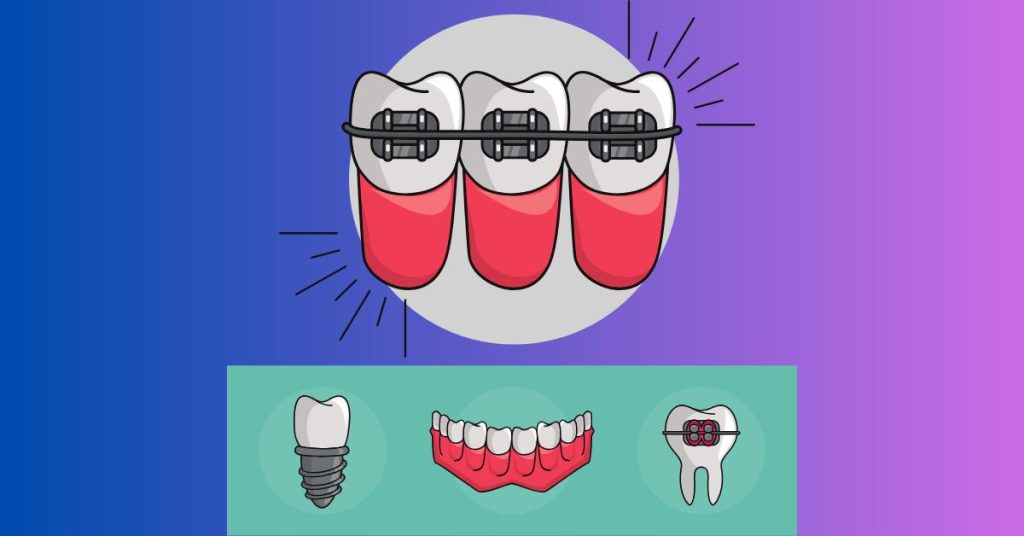 common Braces Faqs